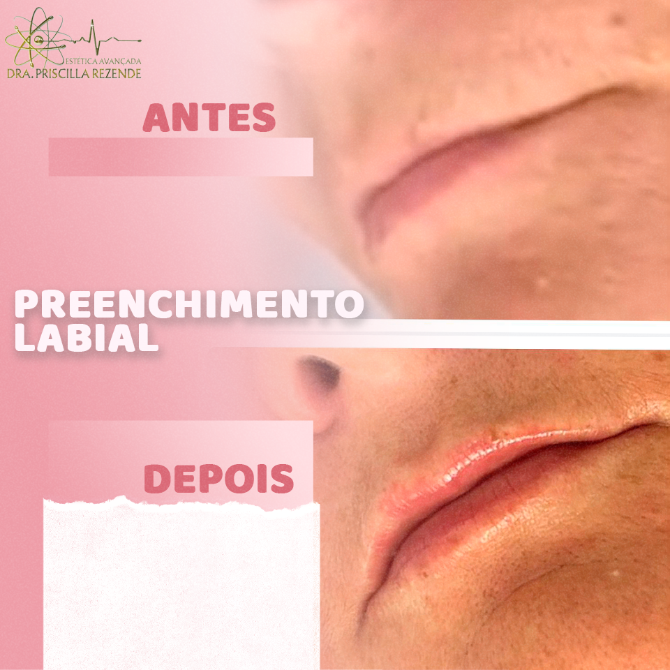 preenchimento labial