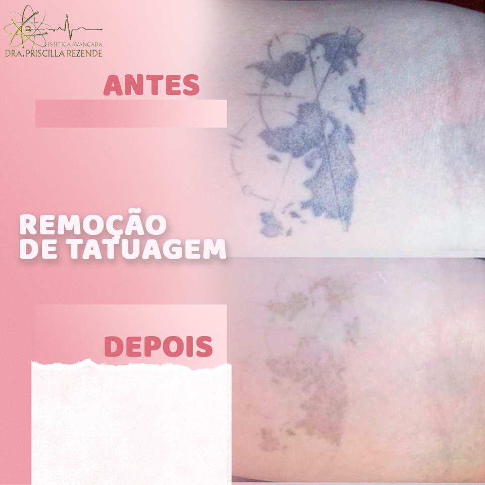 remoção de tatuagem